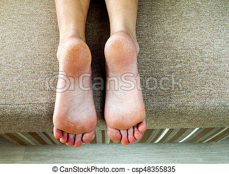 Dry Cracked Skin On Feet